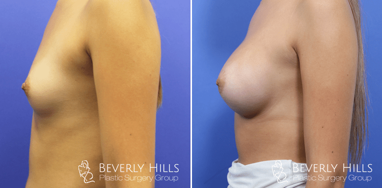 breast-augmentation-case6-before-afters-left-min.png