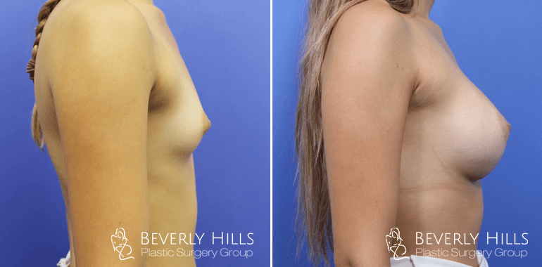 breast-augmentation-case6-before-afters-right-min.png